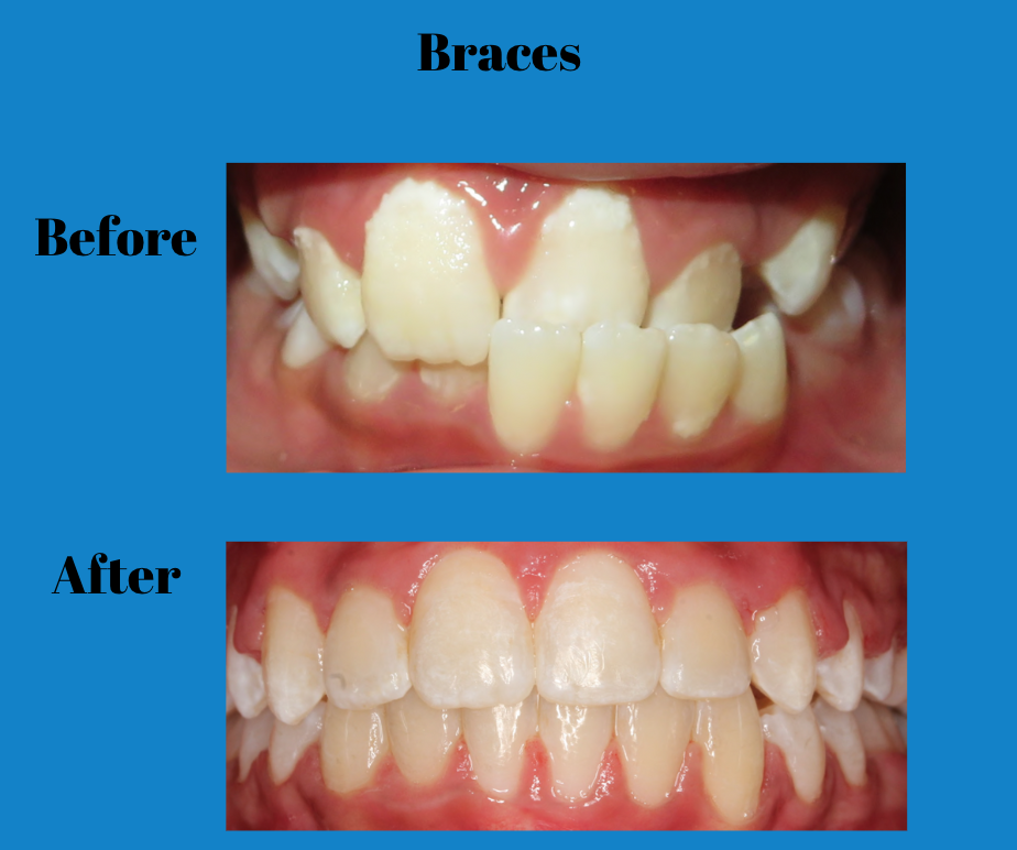 How To Know If You Need Braces Or Not Signs That You Need Braces