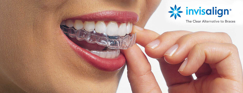 Invisalign Clear Aligners in Spring, TX