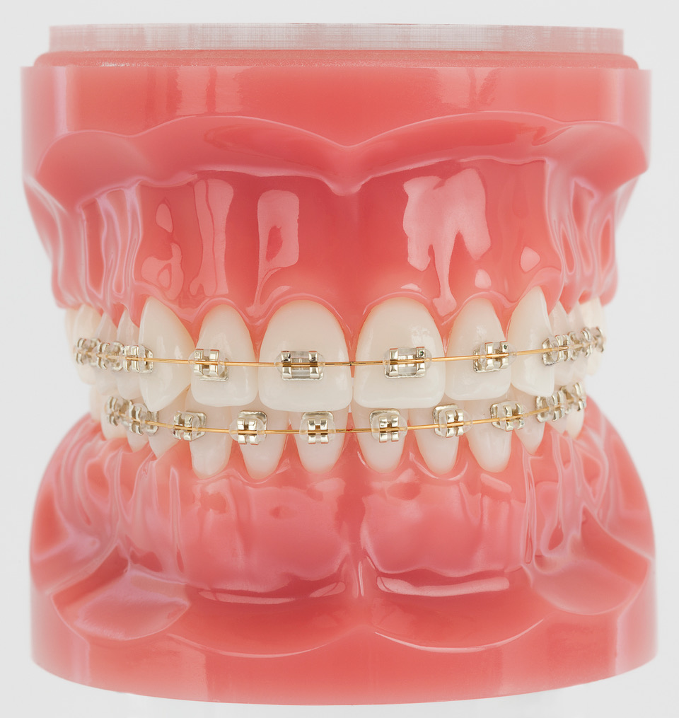 Metal Braces Treatment in Spring, Tx